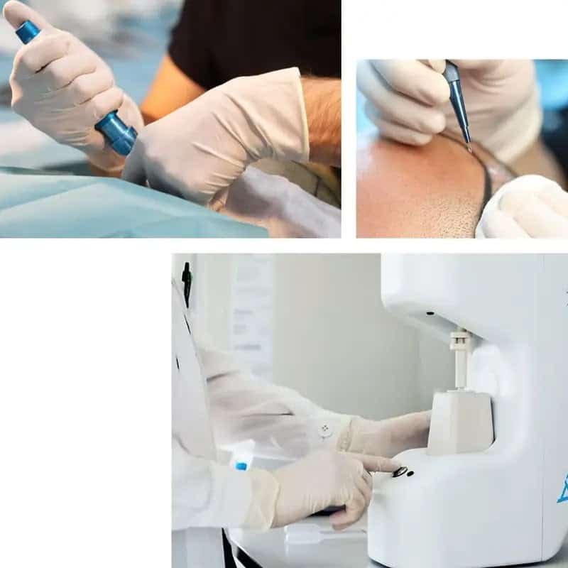 Combined Sapphire FUE and DHI hair transplant treatment at Mercure Istanbul