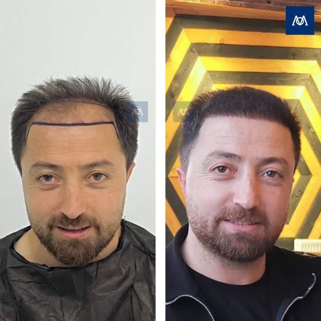 Extensive hair loss transplant result at Mercure Istanbul