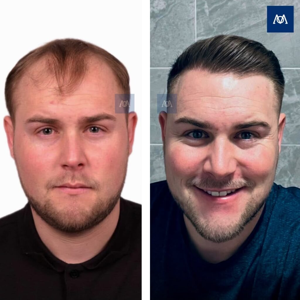 Frontal and mid-scalp hair transplant result at Mercure Istanbul