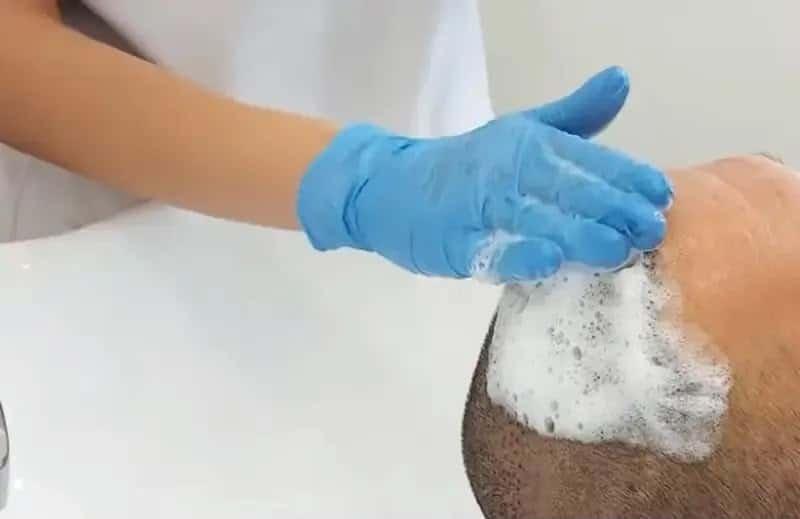 First wash after a hair transplant at Mercure Istanbul