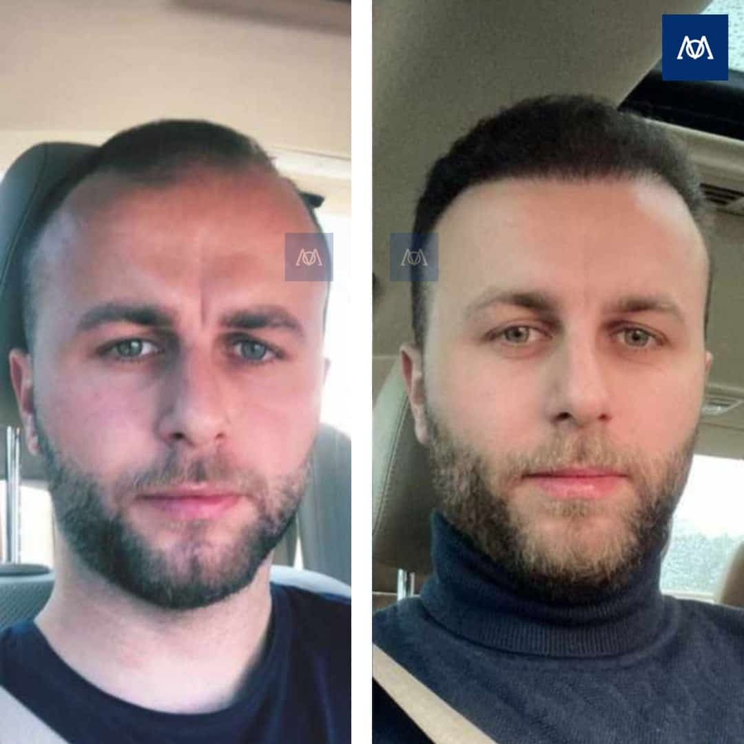 Hairline and frontal hair transplant result at Mercure Istanbul