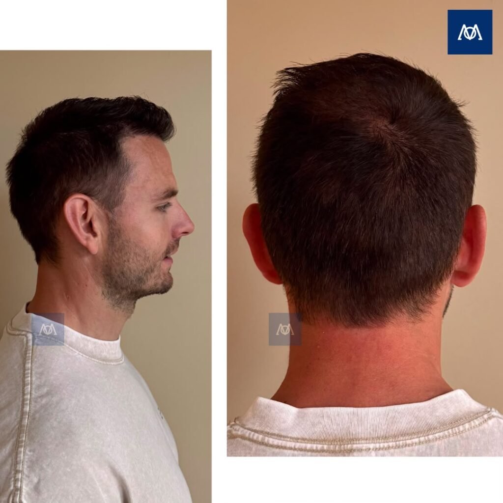 Healed donor area after FUE hair transplantation at Mercure Istanbul