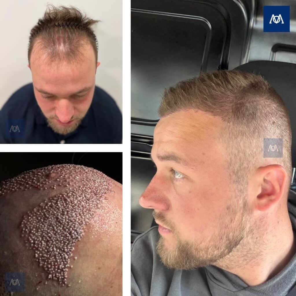 Natural hairline result after hair transplantation at Mercure Istanbul