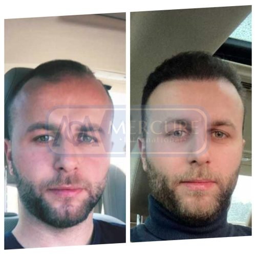 Hair Transplant High Density Turkey Mercure Istanbul Clinics