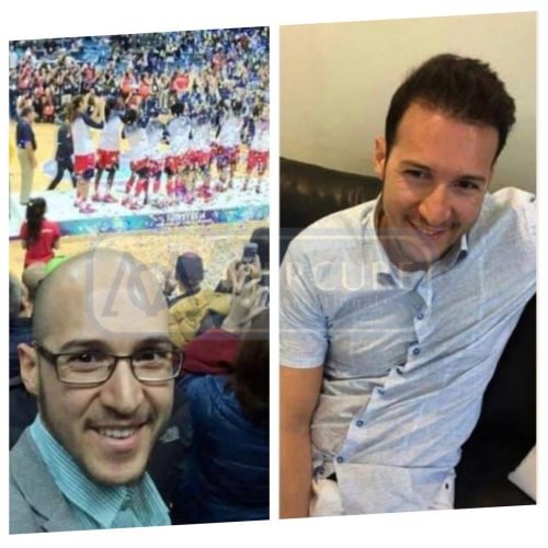 High Density Hair Transplant Mercure Istanbul Clinics